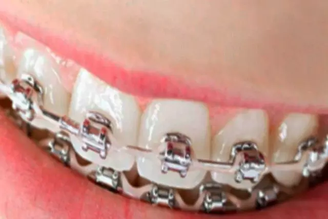 önligírozó fogszabályozó készülék szájban